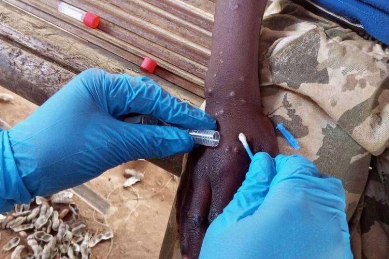 OMS respalda los esfuerzos africanos para combatir la propagación del mpox