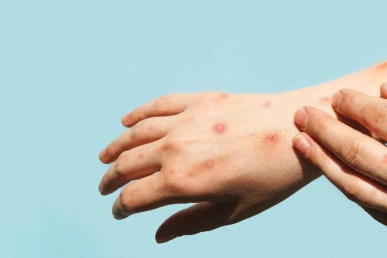 Salud Sinaloa descarta los 4 casos de mpox que tenía registrados como sospechosos; uno permanece activo