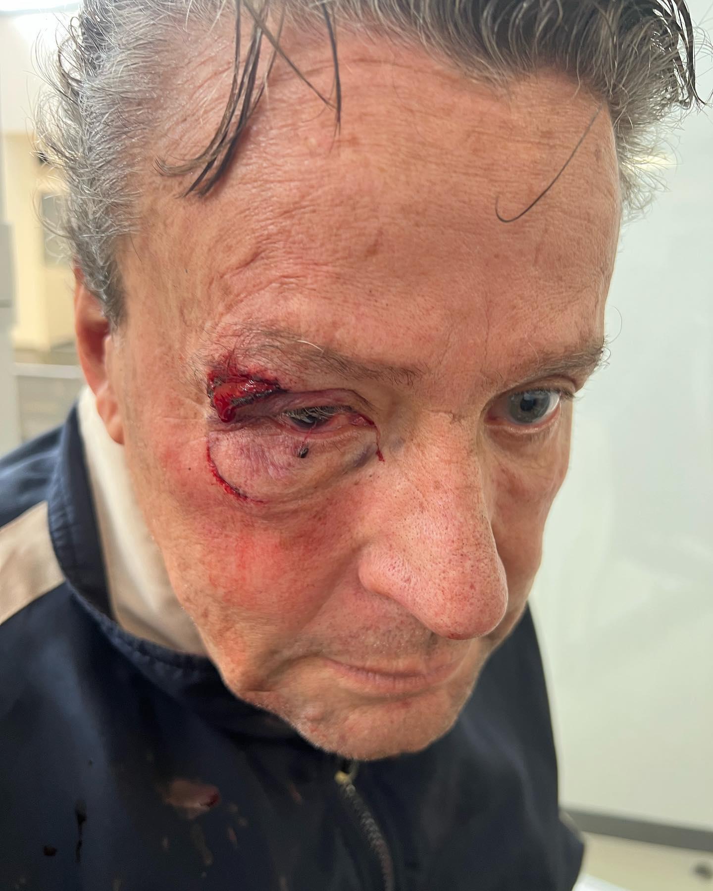 $!Sufre Alfredo Adame fracturas faciales y lesiones en un ojo, tras golpiza que le dieron