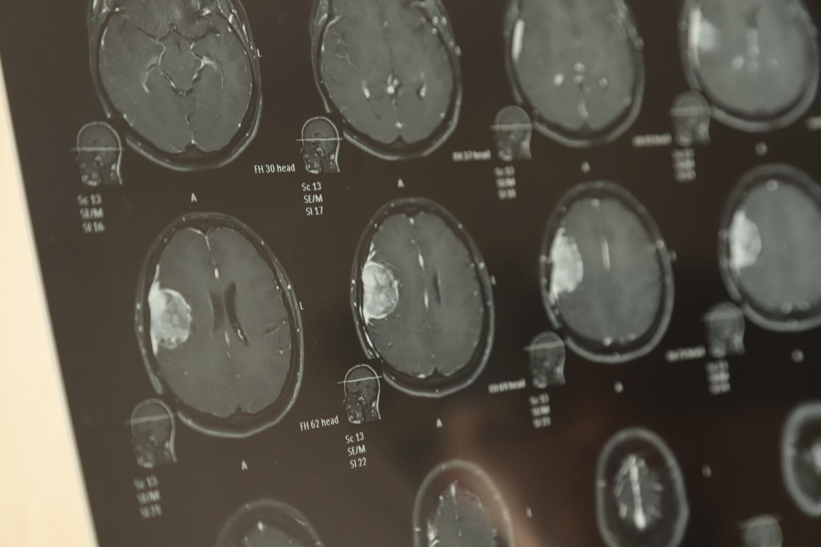 $!Iris Analí clama por ayuda en Mazatlán para costear cirugía por tumor cerebral