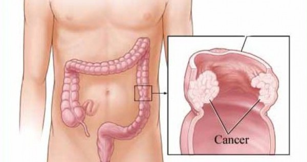 Cáncer colorrectal, el cuarto más frecuente en México