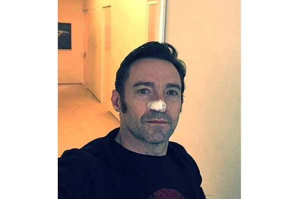 En la imagen, Hugh Jackman aparece con una gasa en la nariz.