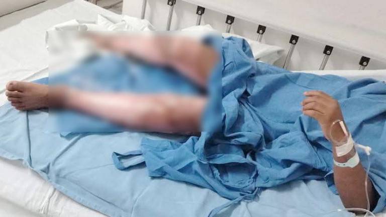 José Luis, de 8 años, sufrió quemaduras en la comunidad de Chilillos, en Rosario, y necesita apoyos para su tratamiento.