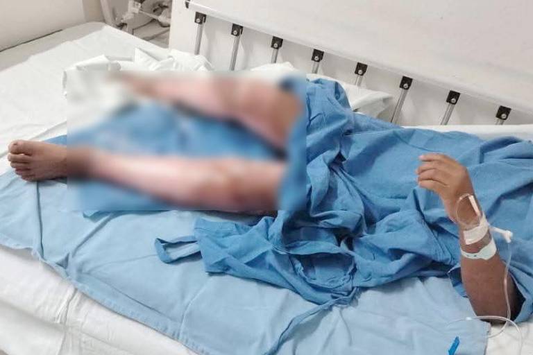 José Luis, de 8 años, sufrió quemaduras en Rosario y requiere ayuda para recibir atención