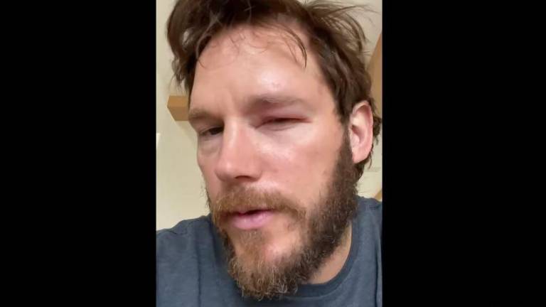 Chris Pratt fue picado por abejas.