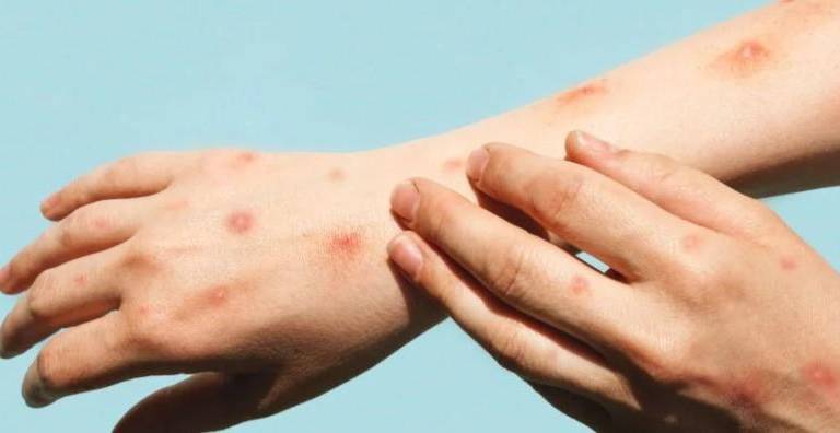 Sinaloa está entre los estados del país que ya presentaron contagios de mpox.