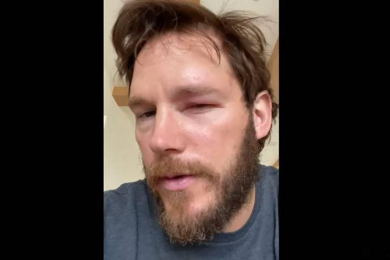 Culpa Chris Pratt a apicultora por picadura de abeja en su ojo
