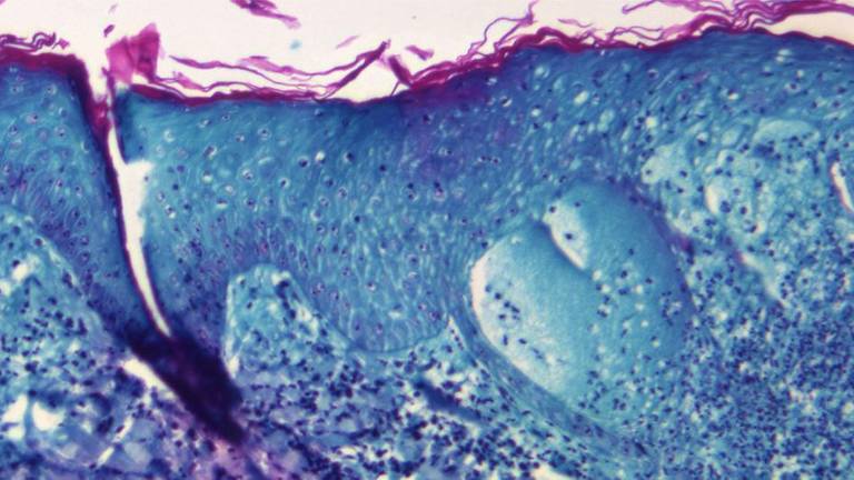 Imagen ampliada de una sección de tejido cutáneo, obtenida de una lesión en la piel de un mono, que había sido infectado con el virus de la viruela del mono.