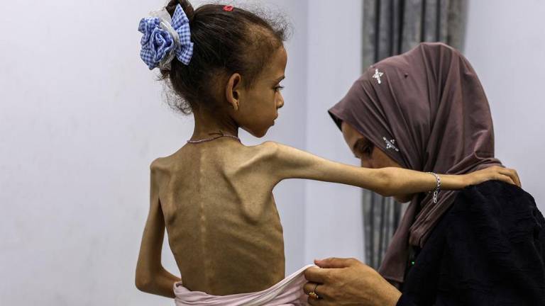 Una niña pequeña con desnutrición grave recibe ayuda para vestirse.