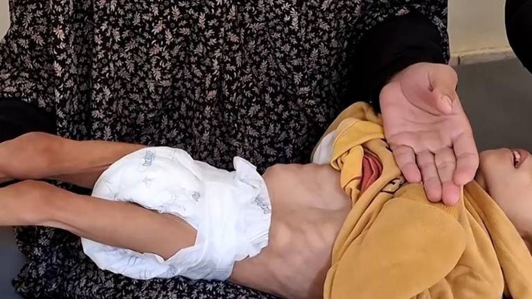 Misk Al-Madhoun, un niño gazatí que sufre hambre y desnutrición.