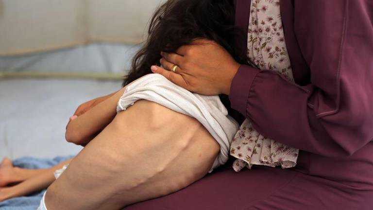 Una niña pequeña con desnutrición grave recibe ayuda para vestirse.