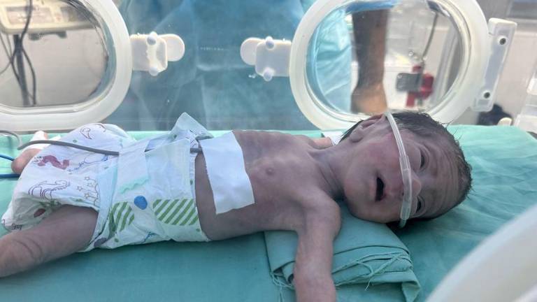 Un bebé gravemente desnutrido recibe tratamiento en el hospital Al Helou en Gaza.
