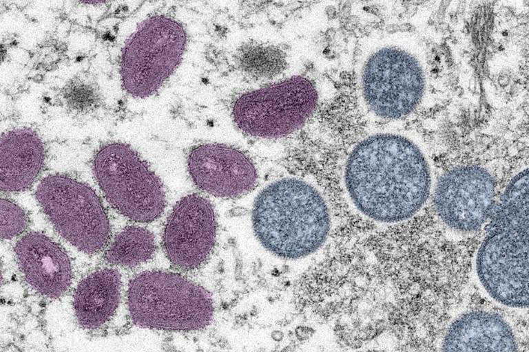 5 puntos clave para entender qué es el Mpox, causas, contagios y síntomas